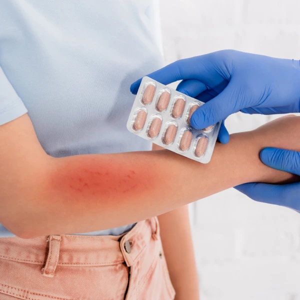 Allergy Treatment