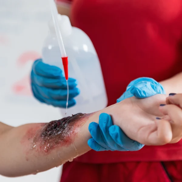 Burn & Thermal Injury Burn & Thermal Injury
