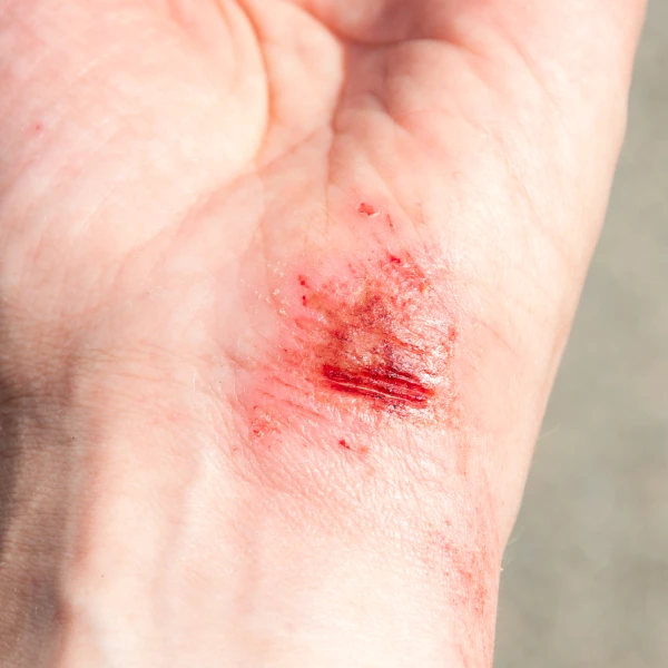 Deep wound Deep wound