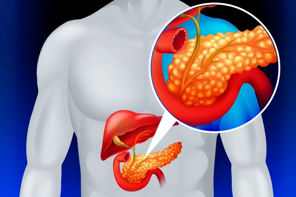 Pancreatitis